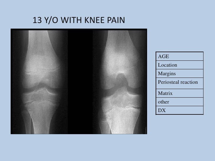 Bone Tumors
