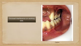 Caption
Occlusal interference on working
side.
 