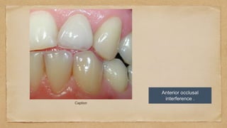 Caption
Anterior occlusal
interference .
 