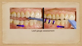 Leaf gauge assessment
 