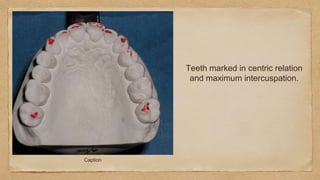 Caption
Teeth marked in centric relation
and maximum intercuspation.
 
