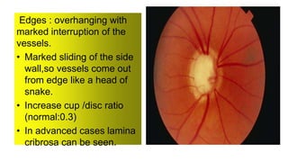 Edges : overhanging with
marked interruption of the
vessels.
• Marked sliding of the side
wall,so vessels come out
from edge like a head of
snake.
• Increase cup /disc ratio
(normal:0.3)
• In advanced cases lamina
cribrosa can be seen.
 