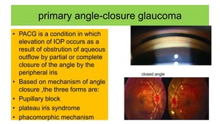 primary angle-closure glaucoma
• PACG is a condition in which
elevation of IOP occurs as a
result of obstrution of aqueous
outflow by partial or complete
closure of the angle by the
peripheral iris
• Based on mechanism of angle
closure ,the three forms are:
• Pupillary block
• plateau iris syndrome
• phacomorphic mechanism
closed angle
 
