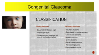 Congenital Glaucoma
 