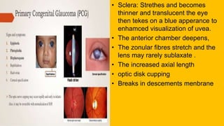 • Sclera: Strethes and becomes
thinner and translucent the eye
then tekes on a blue apperance to
enhamced visualization of uvea.
• The anterior chamber deepens,
• The zonular fibres stretch and the
lens may rarely sublaxate .
• The increased axial length
• optic disk cupping
• Breaks in descements menbrane
 