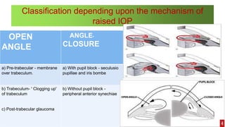 Classification depending upon the mechanism of
raised IOP
OPEN
ANGLE
ANGLE-
CLOSURE
a) Pre-trabecular - membrane
over trabeculum.
a) With pupil block - seculusio
pupillae and iris bombe
b) Trabeculum- ' Clogging up'
of trabeculum
c) Post-trabecular glaucoma
b) Without pupil block -
peripheral anterior synechiae
 