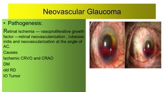 Neovascular Glaucoma
• Pathogenesis:
Retinal ischemia --- vasoproliferative growth
factor ---retinal neovascularization , rubeosis
iridis and neovascularization at the angle of
AC.
Causes:
Ischemic CRVO and CRAO
DM
old RD
IO Tumor
 