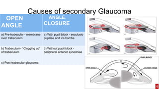 Causes of secondary Glaucoma
OPEN
ANGLE
ANGLE-
CLOSURE
a) Pre-trabecular - membrane
over trabeculum.
a) With pupil block - seculusio
pupillae and iris bombe
b) Trabeculum- ' Clogging up'
of trabeculum
c) Post-trabecular glaucoma
b) Without pupil block -
peripheral anterior synechiae
 