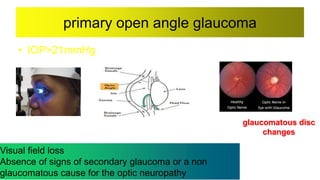 primary open angle glaucoma
• IOP>21mmHg
glaucomatous disc
changes
Visual field loss
Absence of signs of secondary glaucoma or a non
glaucomatous cause for the optic neuropathy
 