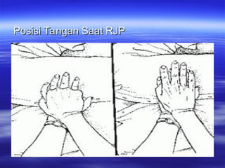 Bhd Rjp Panduan Lengkap Bantuan Hidup Dasar (BHD) dan Teknik RJP | PPT
