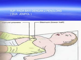 Ppt Rjp Panduan Lengkap Bantuan Hidup Dasar (BHD) dan Teknik RJP | PPT