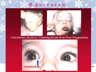B . p e r t u s s is
 