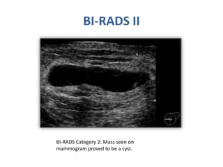 Bi Rads Breast | PPTX