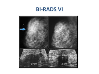 Bi Rads Breast | PPTX