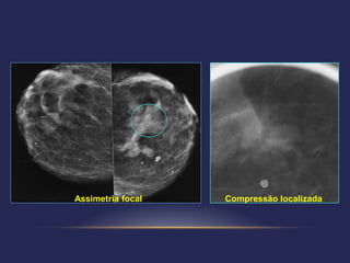 Assimetria focal   Compressão localizada
 