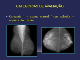 CATEGORIAS DE AVALIAÇÃO


 Categoria 1 – exame normal / sem achados –
  seguimento: rotina
 