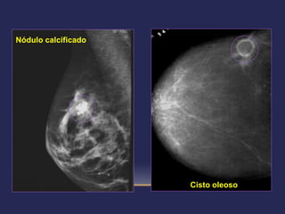 Nódulo calcificado




                     Cisto oleoso
 