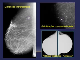 Linfonodo intramamário




                         Calcificações com centro lucente




                          Próteses mamárias – “silicone”
 