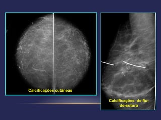 Calcificações cutâneas


        Calcificações cutâneas

                                 Calcificações de fio-
                                       de-sutura
 