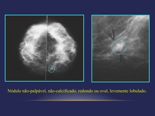 Nódulo não-palpável, não-calcificado, redondo ou oval, levemente lobulado.
 