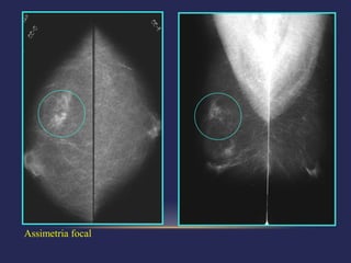 Assimetria focal
 