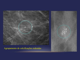 Agrupamento de calcificações redondas
 