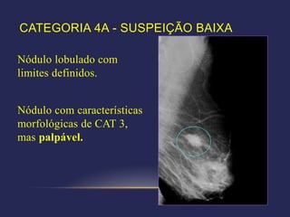 CATEGORIA 4A - SUSPEIÇÃO BAIXA

Nódulo lobulado com
limites definidos.


Nódulo com características
morfológicas de CAT 3,
mas palpável.
 