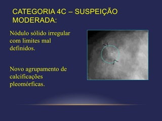CATEGORIA 4C – SUSPEIÇÃO
 MODERADA:
Nódulo sólido irregular
com limites mal
definidos.


Novo agrupamento de
calcificações
pleomórficas.
 