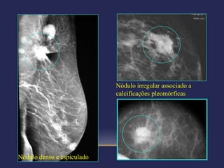 Nódulo irregular associado a
                            calcificações pleomórficas




Nódulo denso e espiculado
 
