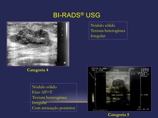 BI-RADS® USG
                            Nódulo sólido
                            Textura heterogênea
                            Irregular




Categoria 4


  Nódulo sólido
  Eixo AP>T
  Textura heterogênea
  Irregular
  Com atenuação posterior
                                     Categoria 5
 