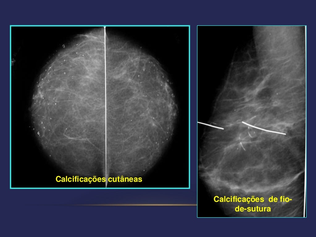 Bi rads 3, 4 e 5 - como conduzir
