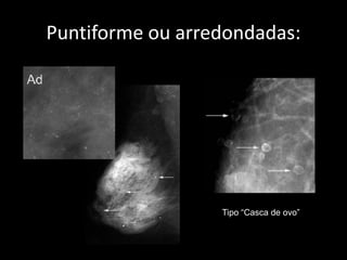 Puntiforme ou arredondadas:




                  Tipo “Casca de ovo”
 