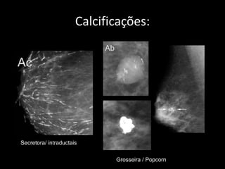 Calcificações:




Secretora/ intraductais


                             Grosseira / Popcorn
 