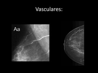 Vasculares:
 