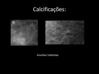 Calcificações:




 Amorfas/ indistintas
 