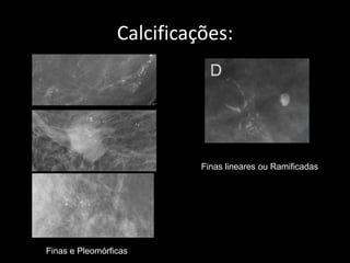 Calcificações:




                           Finas lineares ou Ramificadas




Finas e Pleomórficas
 