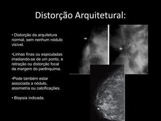 Distorção Arquitetural:
• Distorção da arquitetura
normal, sem nenhum nódulo
visível.

•Linhas finas ou espiculadas
irradiando-se de um ponto, e
retração ou distorção focal
da margem do parênquima.

•Pode também estar
associada a nódulo,
assimetria ou calcificações.

• Biopsia indicada.
 