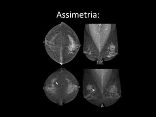 Assimetria:
 
