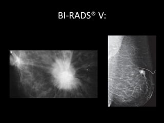 BI-RADS® V:
 