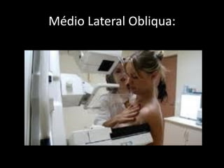 Médio Lateral Obliqua:
 