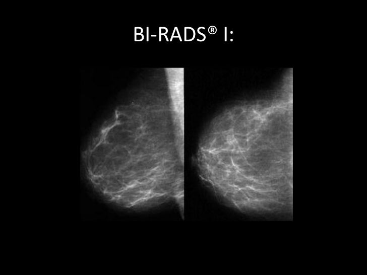 Bi rads 0. Фиброзно кистозная мастопатия молочной железы bi-rads-4a. Маммография bi-rads 4 Тип 4. Маммография шкала bi-rads. Категория bi-rads 1.