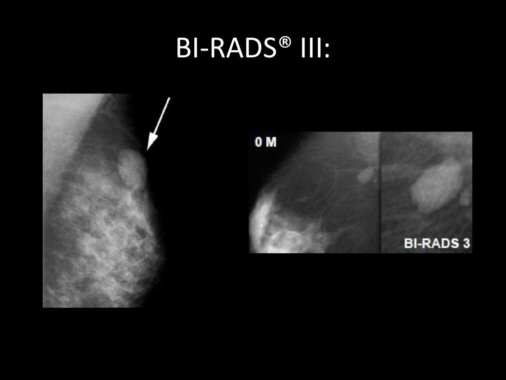 Bi rads md. Маммография классификация bi-rads. Фиброзно кистозная мастопатия молочной железы bi-rads-4a. Классификация молочной железы bi rads. Bi-rads 3 молочной железы маммограмма.