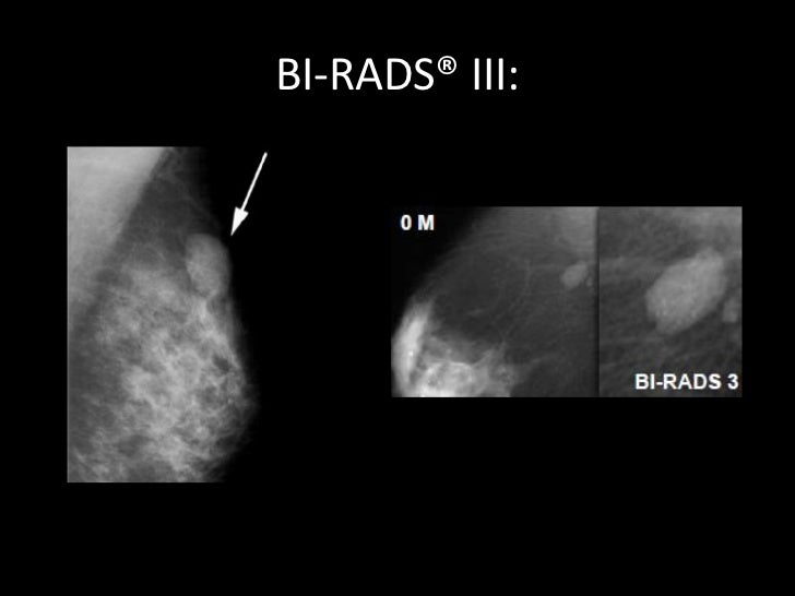 Категории маммографии. Маммография классификация bi-rads. Фиброзно кистозная мастопатия молочной железы bi-rads-4a. Классификация молочной железы bi rads. Bi-rads 3 молочной железы маммограмма.