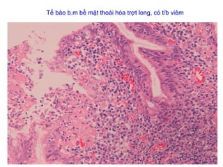 Tế bào b.m bề mặt thoái hóa trợt long, có t/b viêm
 