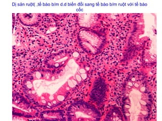 Dị sản ruột( ,tế bào b/m d.d biến đổi sang tế bào b/m ruột với tế bào
cốc
 