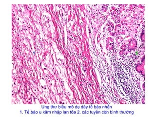 Ung thư biểu mô dạ dày tế bào nhẫn
1. Tế bào u xâm nhập lan tỏa 2. các tuyến còn bình thường
1 2
 