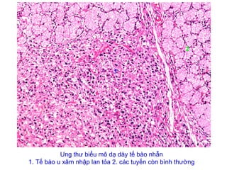 Ung thư biểu mô dạ dày tế bào nhẫn
1. Tế bào u xâm nhập lan tỏa 2. các tuyến còn bình thường
1
2
 