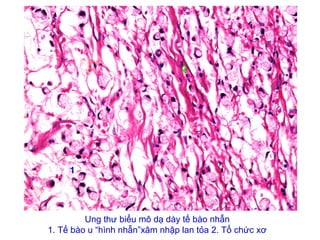 Ung thư biểu mô dạ dày tế bào nhẫn
1. Tế bào u “hình nhẫn”xâm nhập lan tỏa 2. Tổ chức xơ
1
2
 