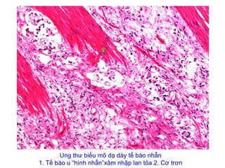 Ung thư biểu mô dạ dày tế bào nhẫn
1. Tế bào u “hình nhẫn”xâm nhập lan tỏa 2. Cơ trơn
1
2
 