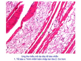 Ung thư biểu mô dạ dày tế bào nhẫn
1. Tế bào u “hình nhẫn”xâm nhập lan tỏa 2. Cơ trơn
1
2
 